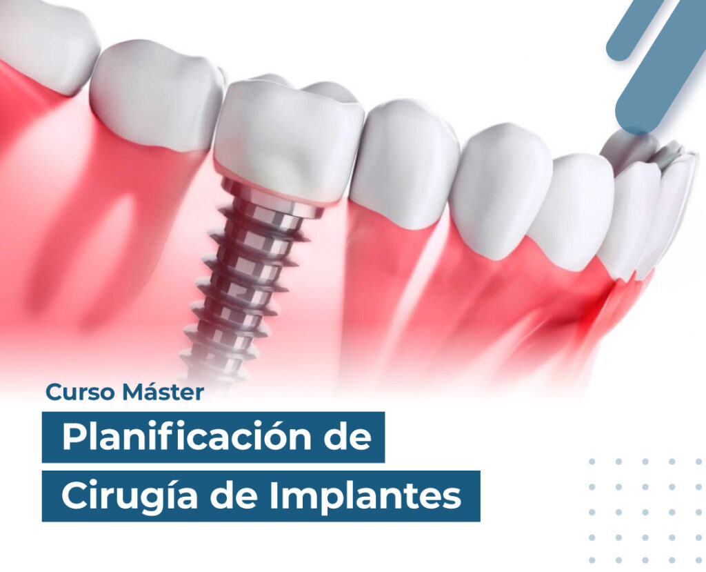 Modulo 1: Curso Planificación de Cirugía de Implantes dentales.