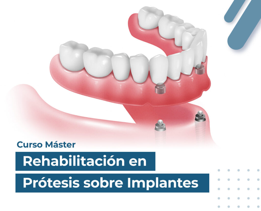 Modulo 3: Curso Regenaciónes Rahabilitación en Prótesis sobre Implantes.