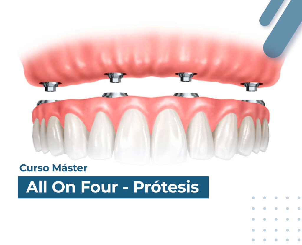 Curso Especializado ALL ON FOUR PRÓTESIS.