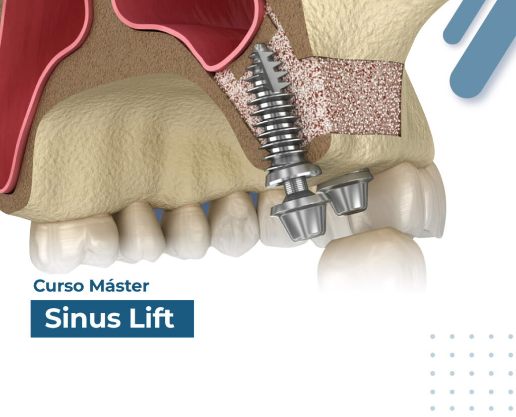 Curso Especializado SINUS LIFT.